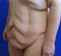 Belt lipectomy before photo