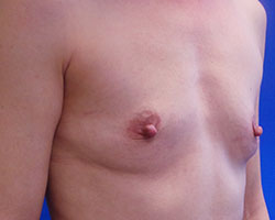 Breast augmentation before photo